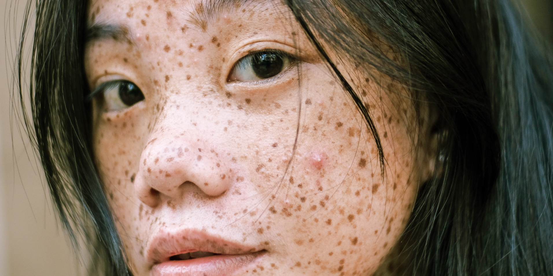 Hyperpigmentation